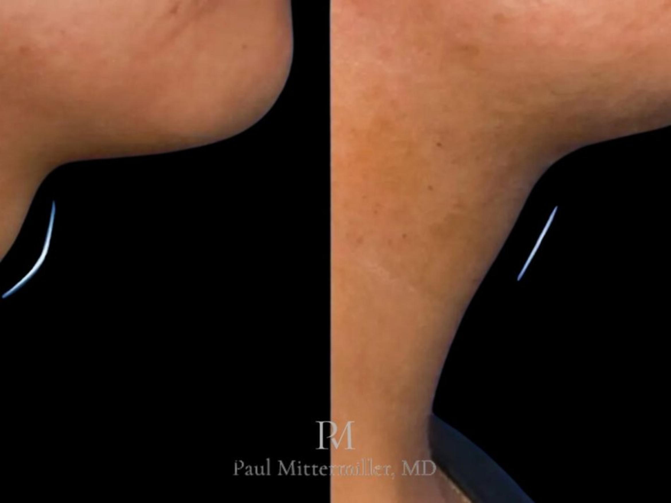 Before & After Facial Feminization Surgery Case 102 View 1 View in San Francisco, Los Angeles, CA