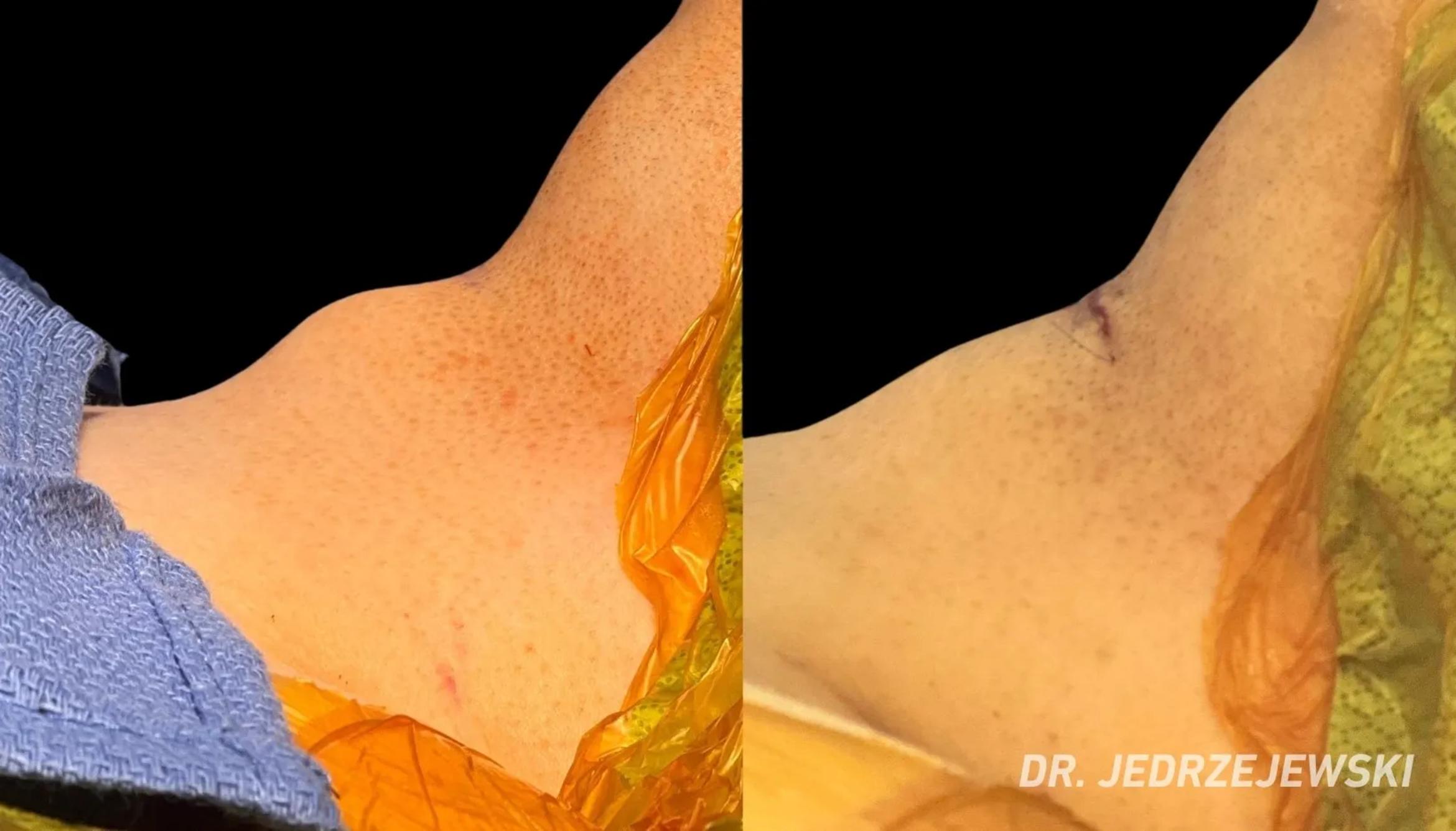 Before & After Facial Feminization Surgery Case 104 View 1 View in San Francisco, Los Angeles, CA