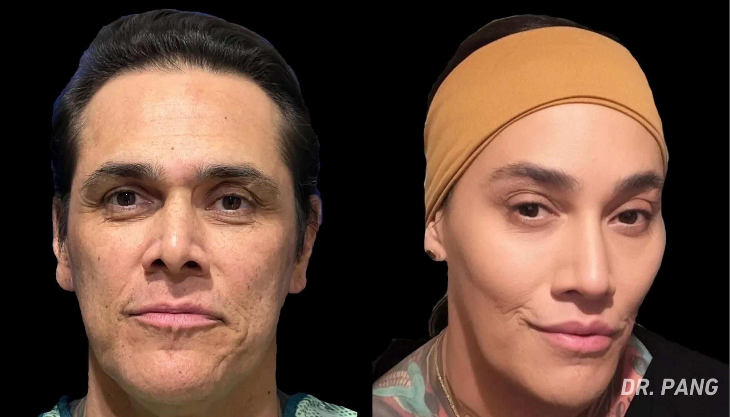 Before & After Facial Feminization Surgery Case 106 View 1 View in San Francisco, Los Angeles, CA