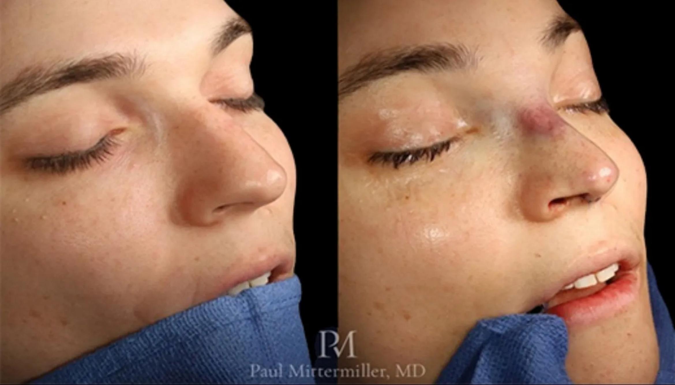 Before & After Facial Feminization Surgery Case 111 View 1 View in San Francisco, Los Angeles, CA