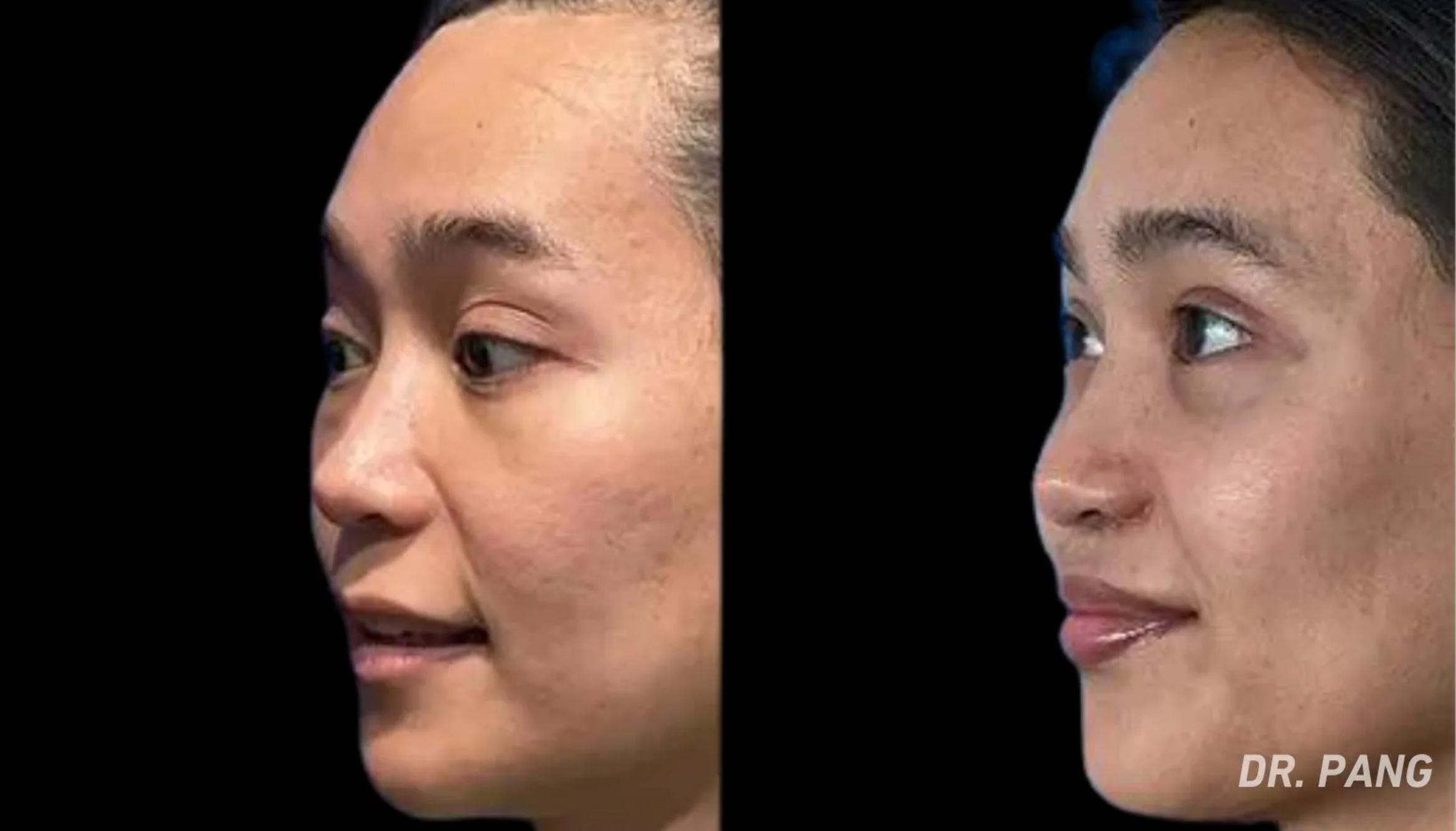Before & After Facial Feminization Surgery Case 112 View 1 View in San Francisco, Los Angeles, CA