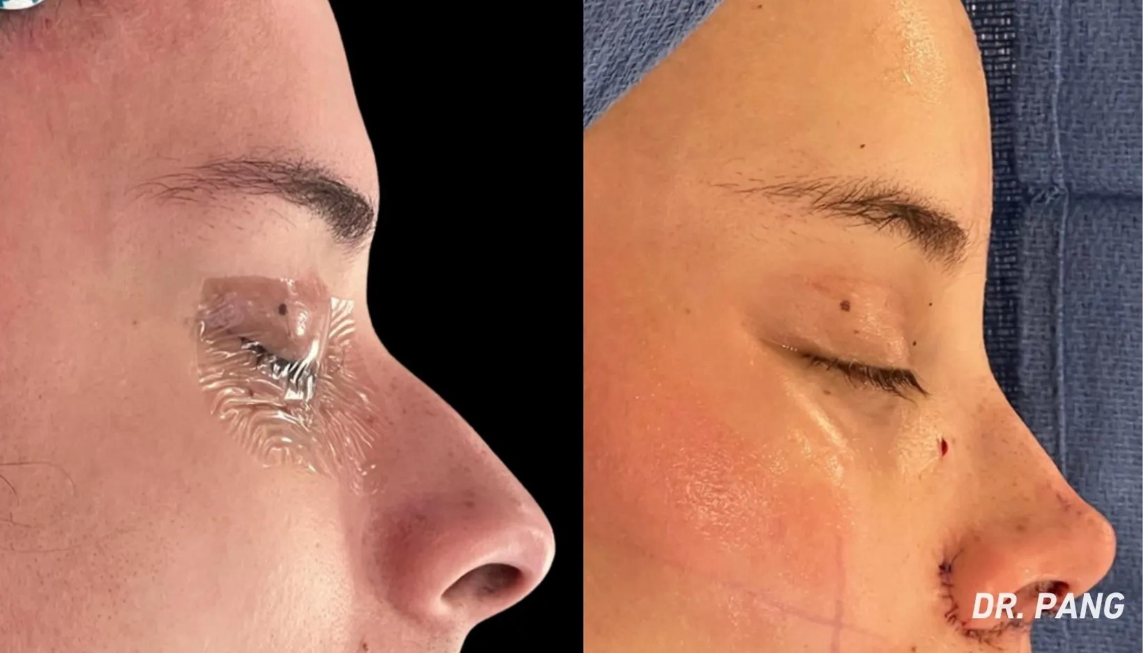 Before & After Facial Feminization Surgery Case 124 View 1 View in San Francisco, Los Angeles, CA