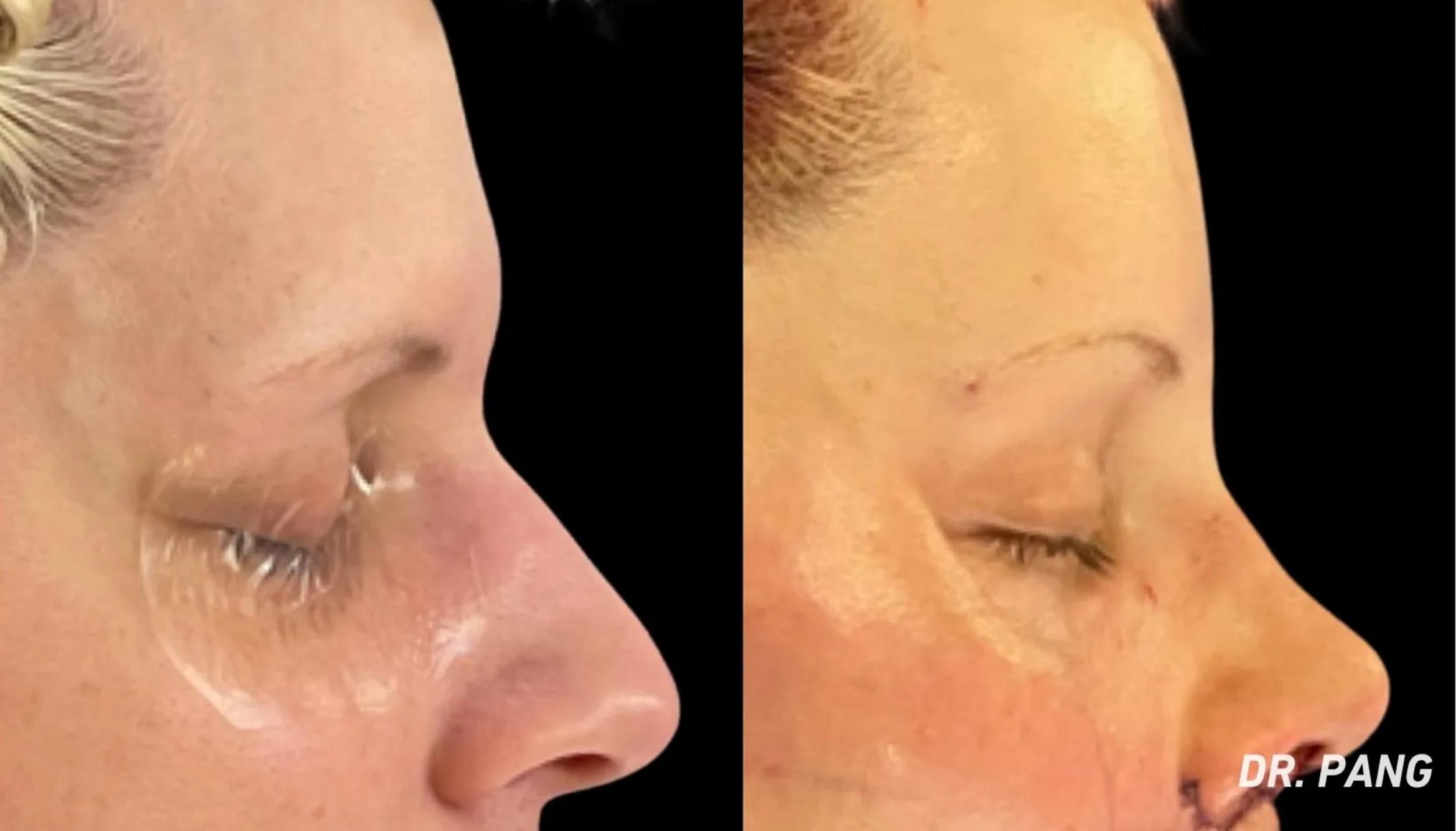 Before & After Facial Feminization Surgery Case 128 View 1 View in San Francisco, Los Angeles, CA