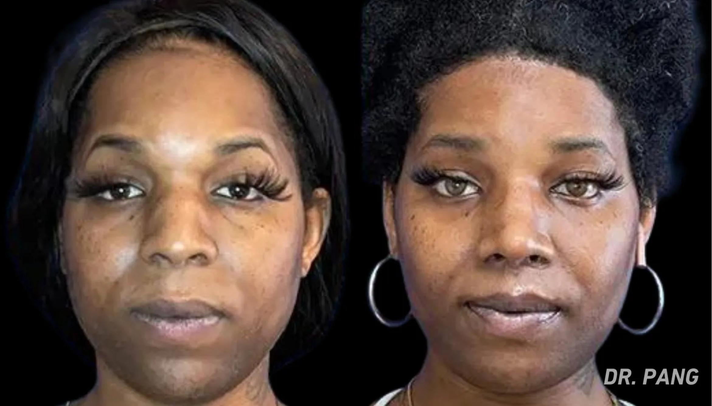 Before & After Facial Feminization Surgery Case 137 View 1 View in San Francisco, Los Angeles, CA