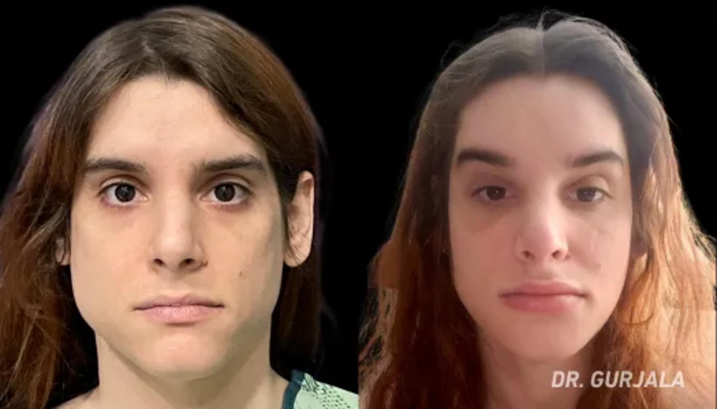 Before & After Facial Feminization Surgery Case 17 View 1 View in San Francisco, Los Angeles, CA