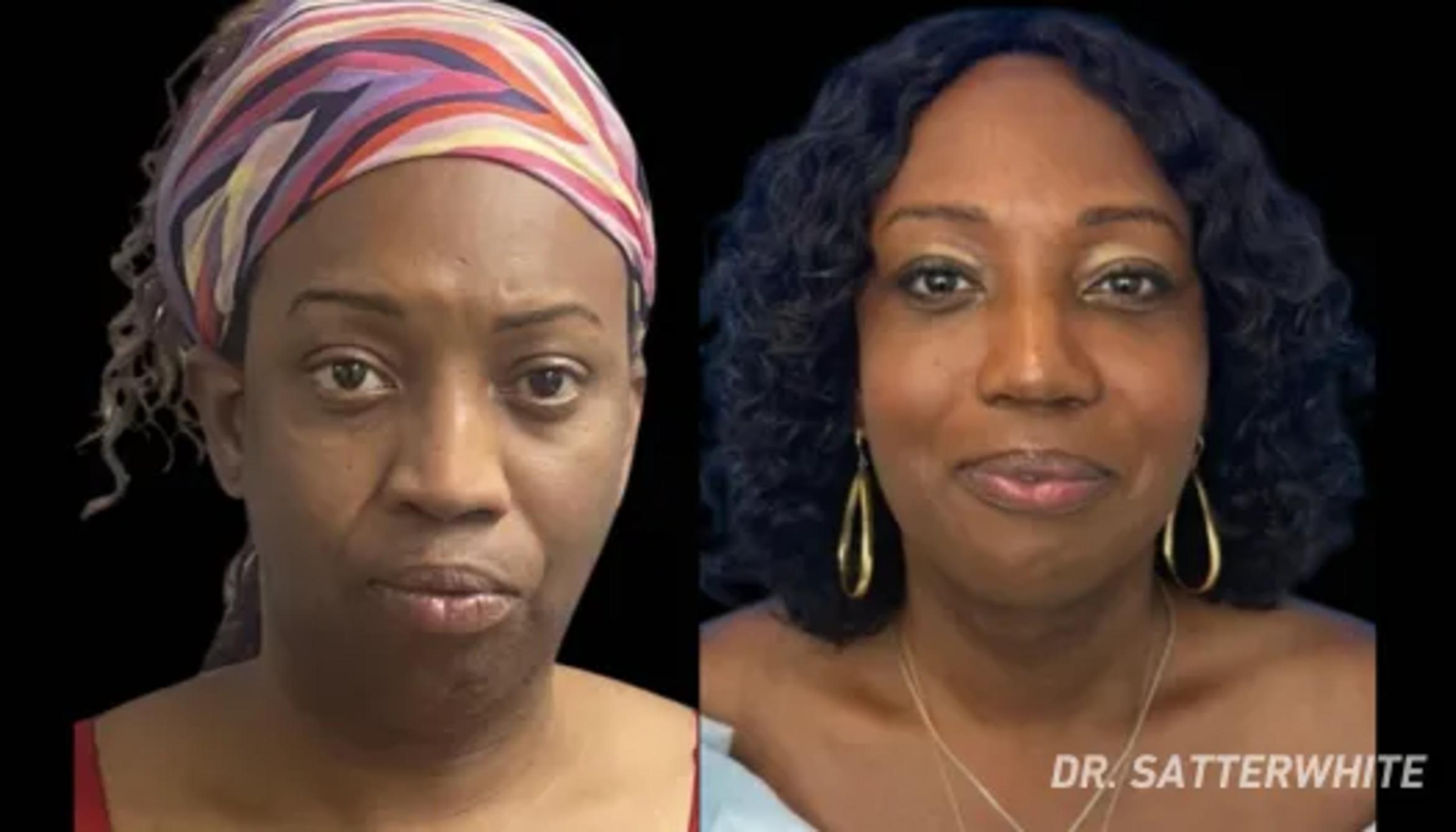 Before & After Facial Feminization Surgery Case 25 View 1 View in San Francisco, Los Angeles, CA