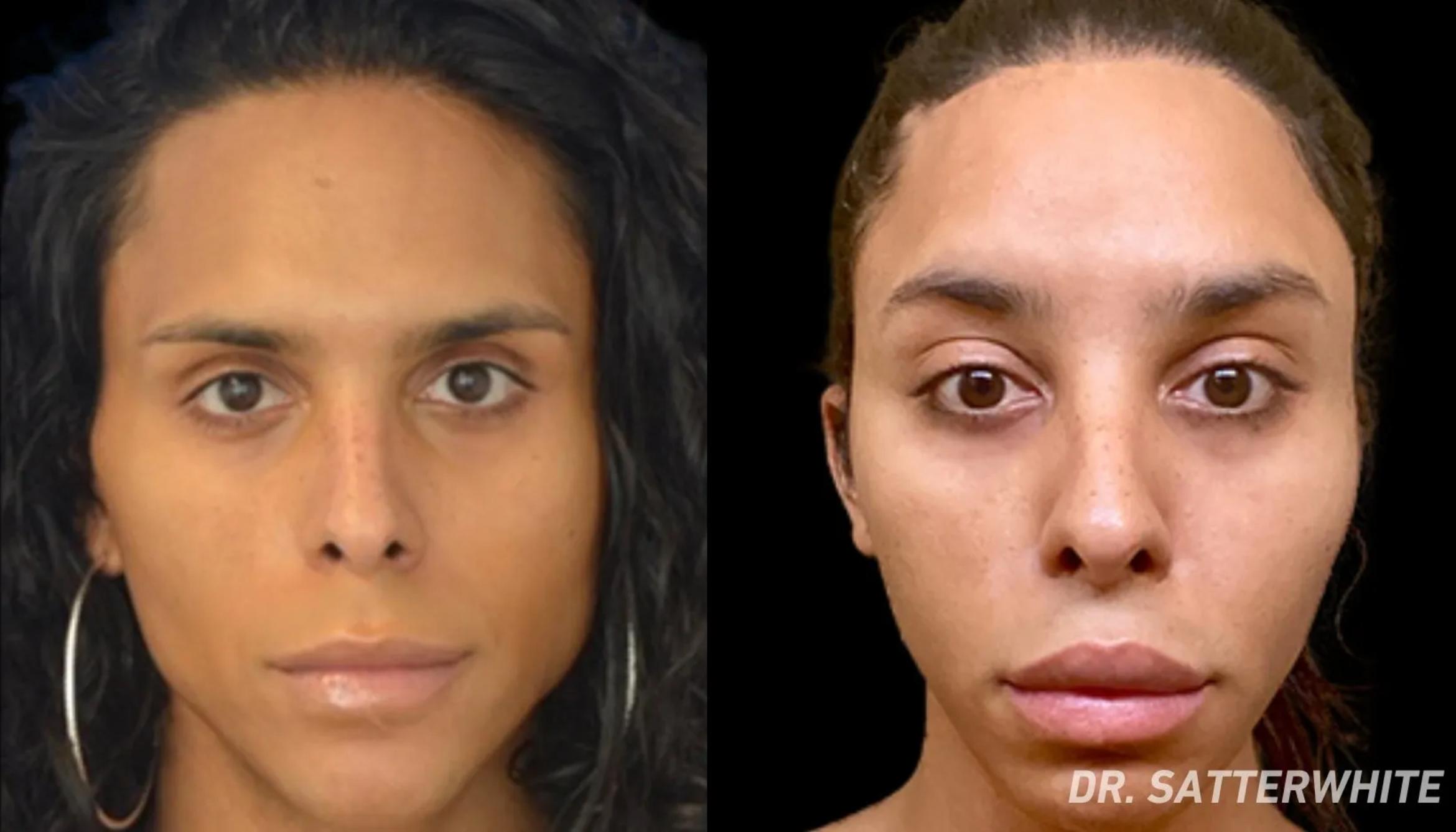 Before & After Facial Feminization Surgery Case 29 View 1 View in San Francisco, Los Angeles, CA