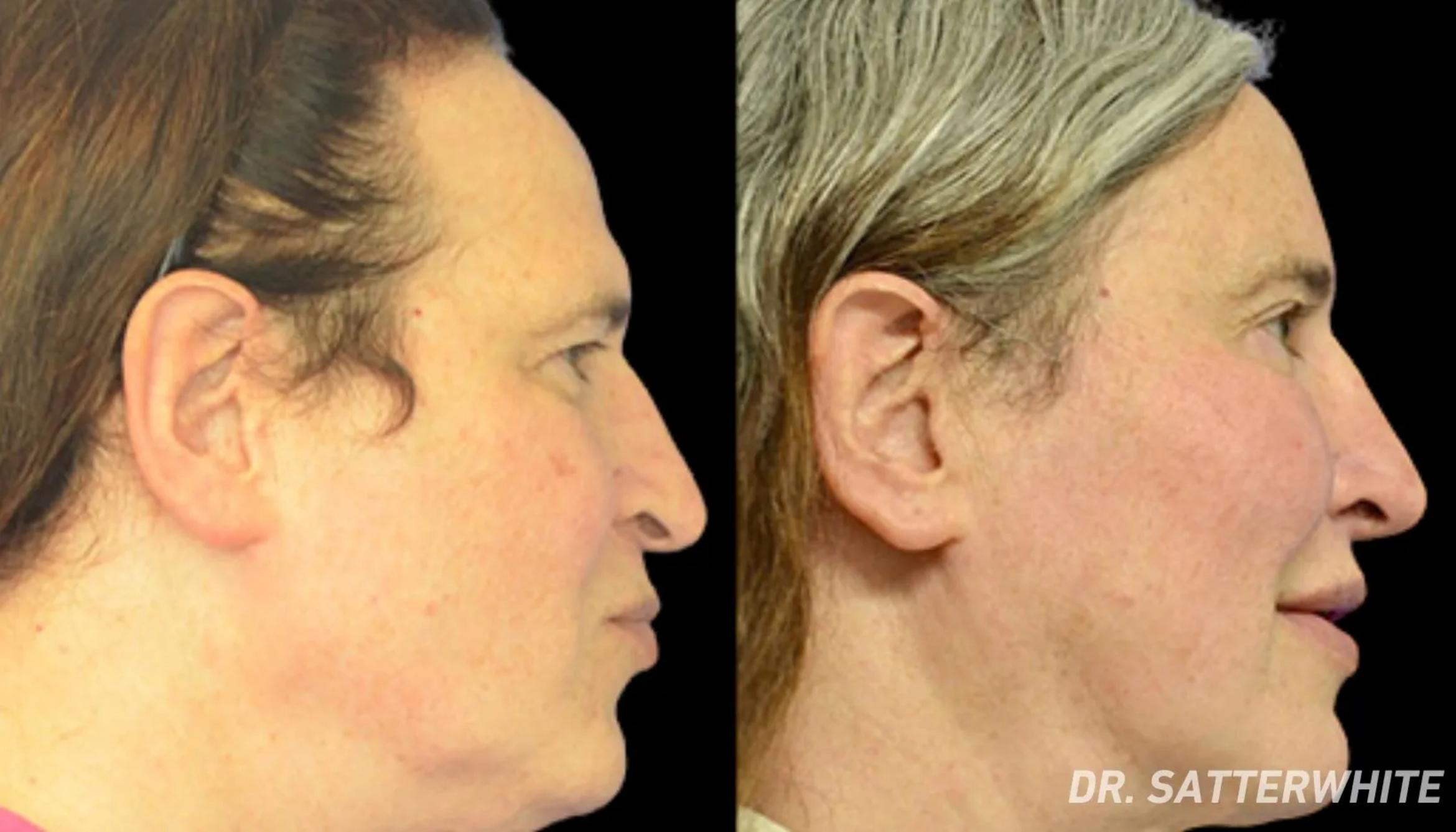 Before & After Facial Feminization Surgery Case 36 View 1 View in San Francisco, Los Angeles, CA