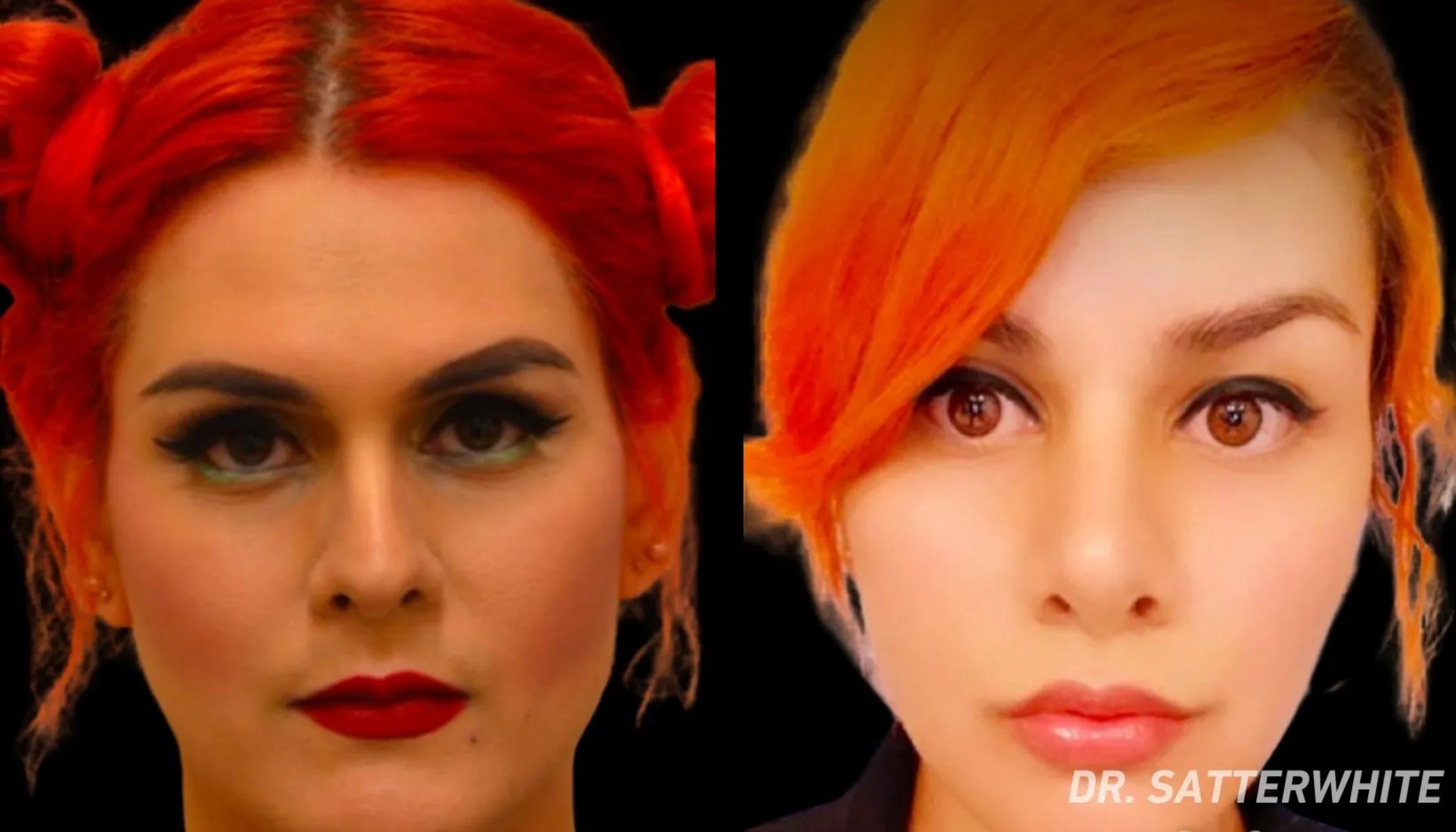 Before & After Facial Feminization Surgery Case 40 View 1 View in San Francisco, Los Angeles, CA