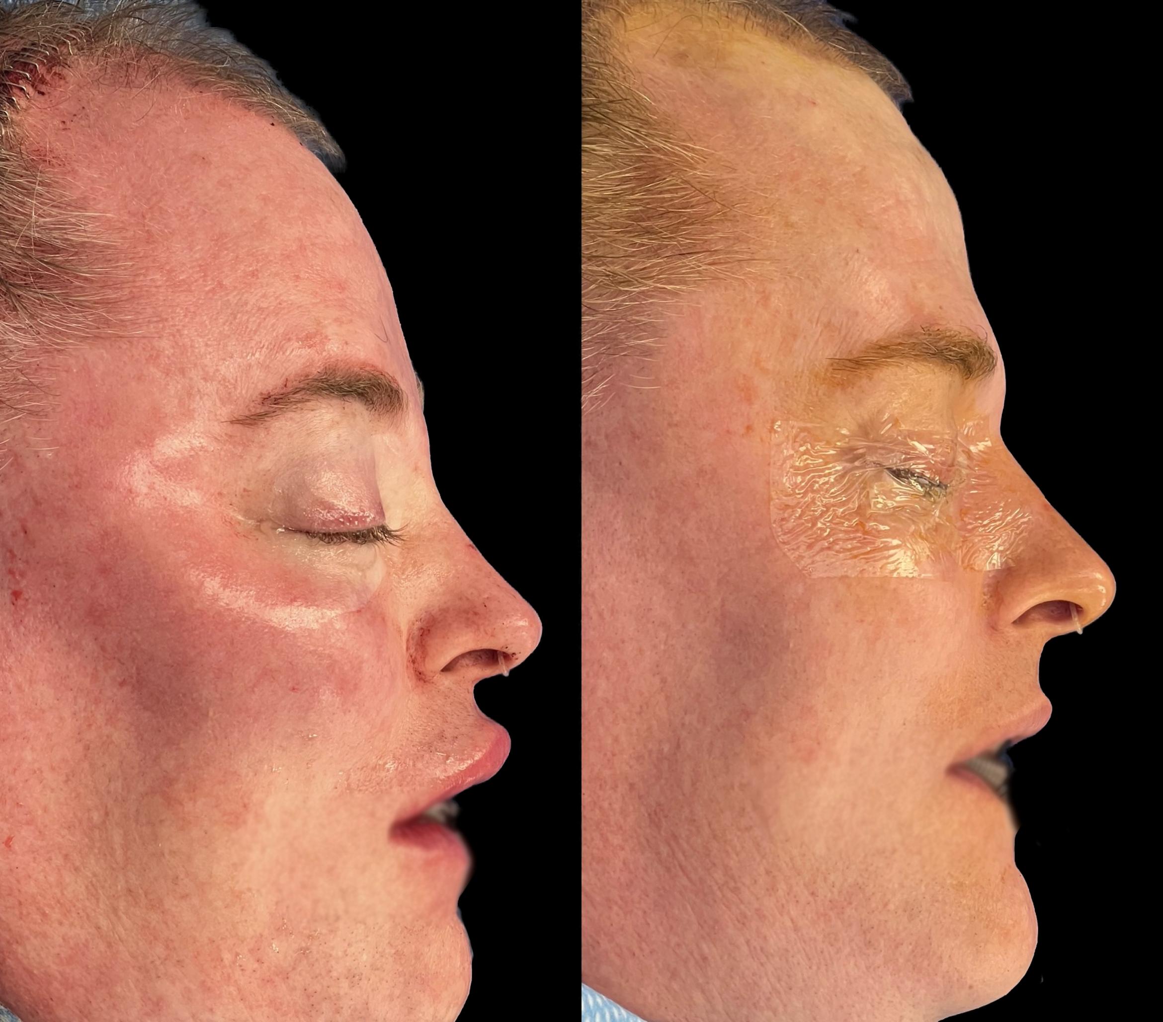 Before & After Facial Feminization Surgery Case 474 Right Side View in San Francisco, Los Angeles, CA