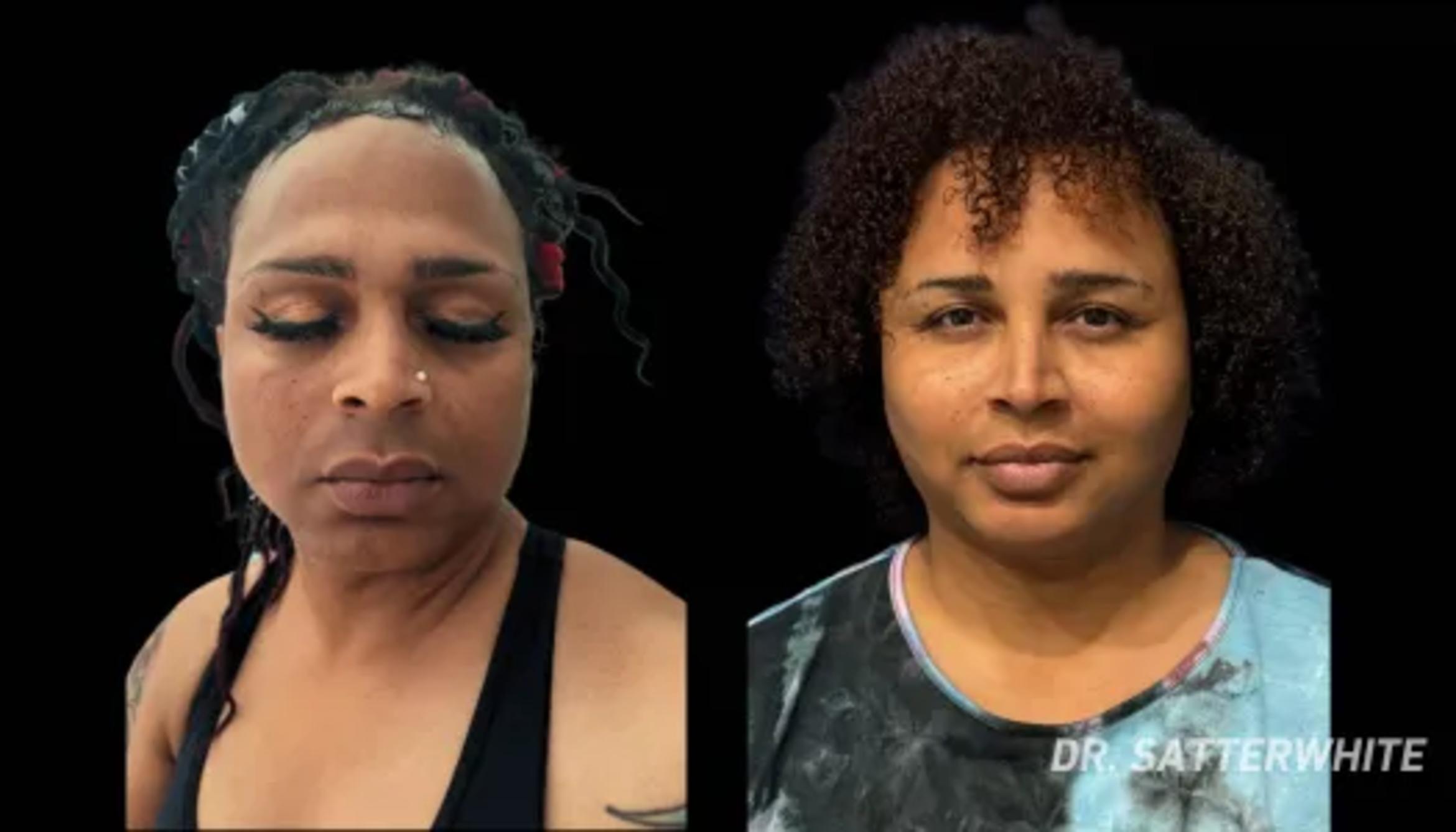 Before & After Facial Feminization Surgery Case 6 View 1 View in San Francisco, Los Angeles, CA
