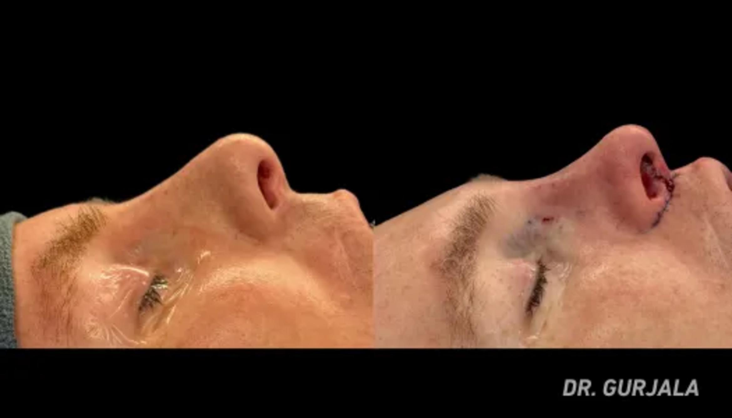 Before & After Facial Feminization Surgery Case 75 View 1 View in San Francisco, Los Angeles, CA