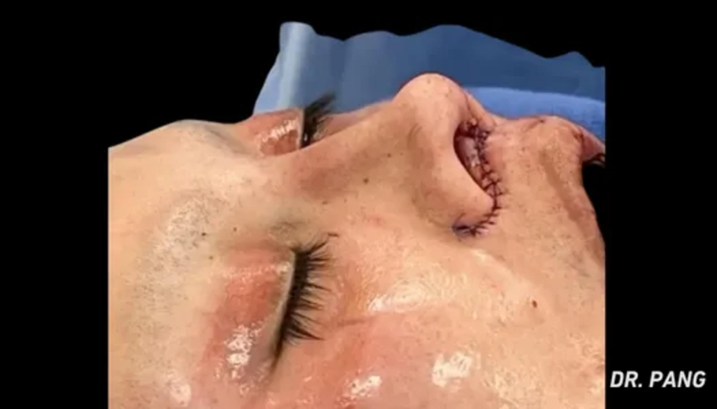 Before & After Facial Feminization Surgery Case 87 View 1 View in San Francisco, Los Angeles, CA
