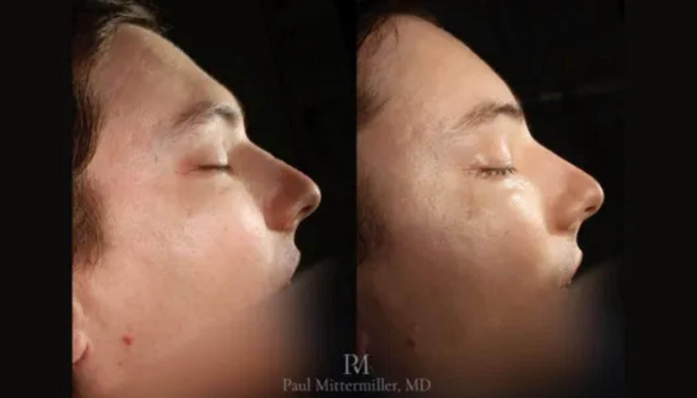 Before & After Facial Feminization Surgery Case 94 View 1 View in San Francisco, Los Angeles, CA