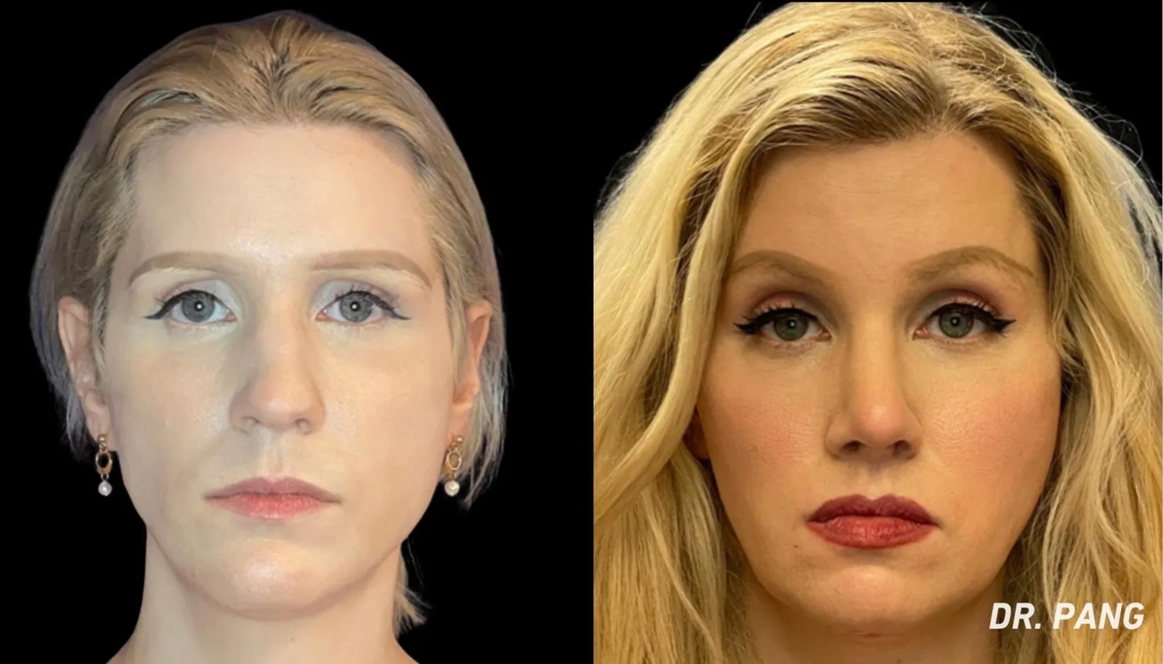 Before & After Facial Feminization Surgery Case 132 View 1 View in San Francisco, Los Angeles, CA