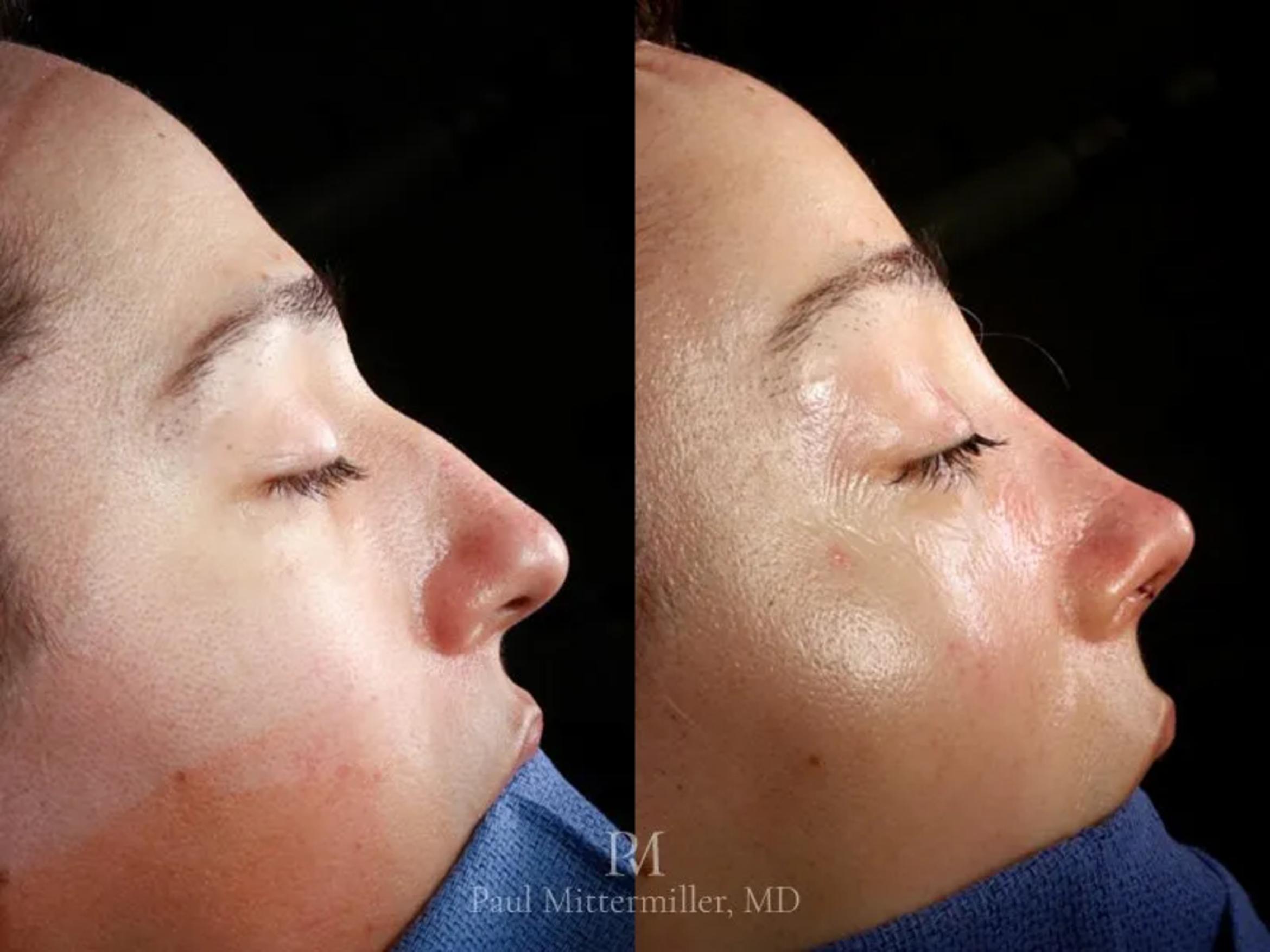Before & After Facial Feminization Surgery Case 144 View 1 View in San Francisco, Los Angeles, CA