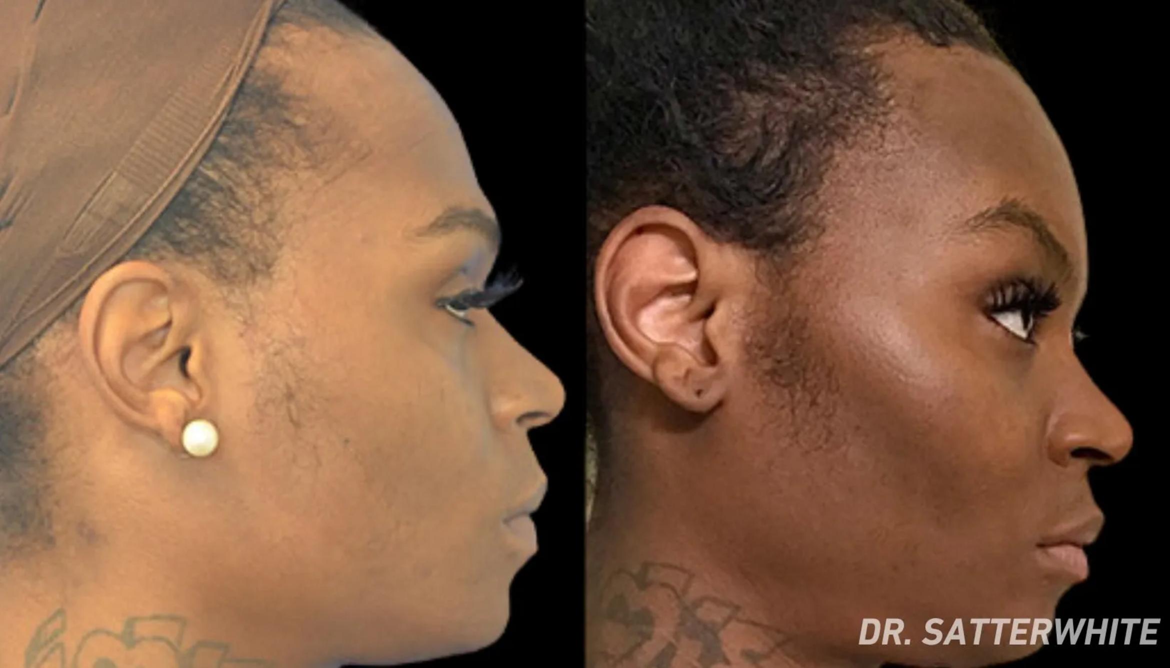Before & After Facial Feminization Surgery Case 57 View 1 View in San Francisco, Los Angeles, CA