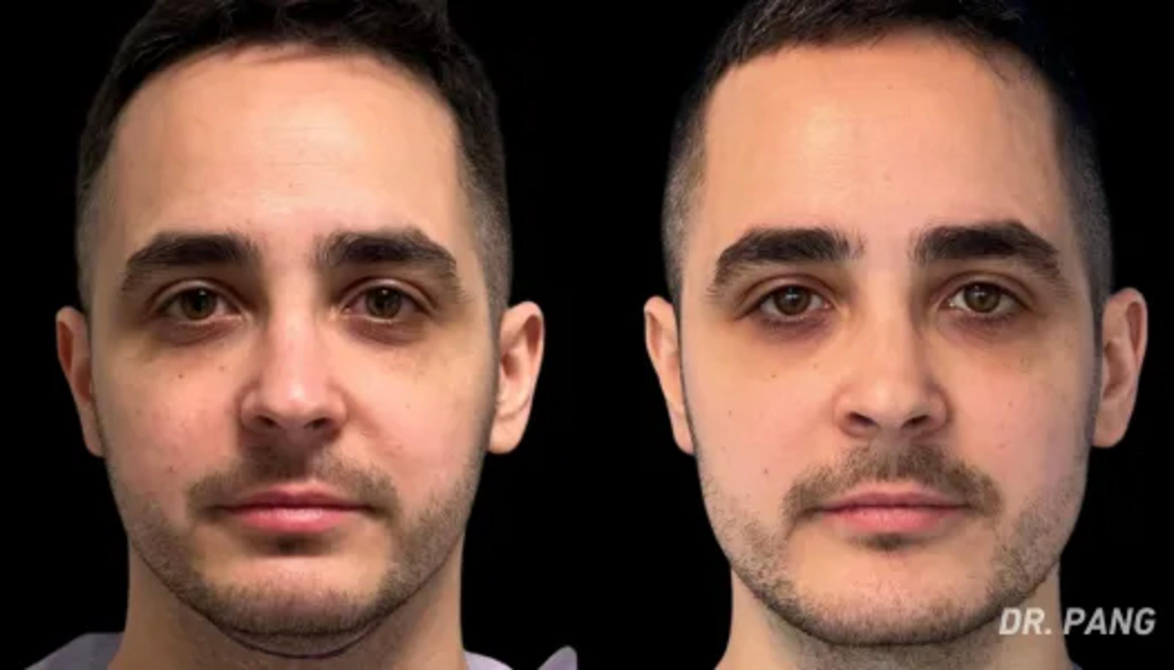 Before & After Facial Masculinization Surgery Case 145 View 1 View in San Francisco, Los Angeles, CA